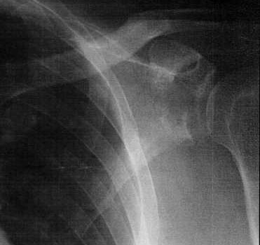 X-ray of broken shoulder