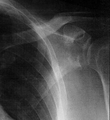 X-ray of broken shoulder